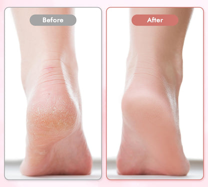 SoleRenew™ – Electric Callus Remover & Foot Care Wand